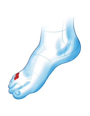 Klin międzypalcowy na mały palec tzw. palec krawca Mazbit Separator Duo Mini MS470 para