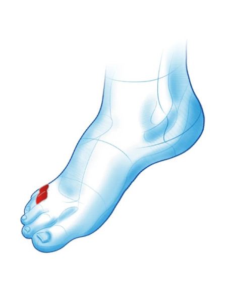 Klin międzypalcowy na mały palec tzw. palec krawca Mazbit Separator Duo Mini MS470 para