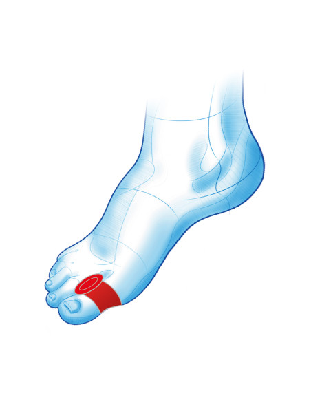 Kliny żelowe na halluksy z pierścieniem na paluch Haluks Duo